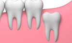含歯性嚢胞（がんしせいのうほう）の予防