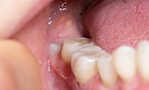 第二大臼歯（親知らずの1つ手前の歯）の保全