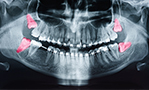 歯列不正の予防